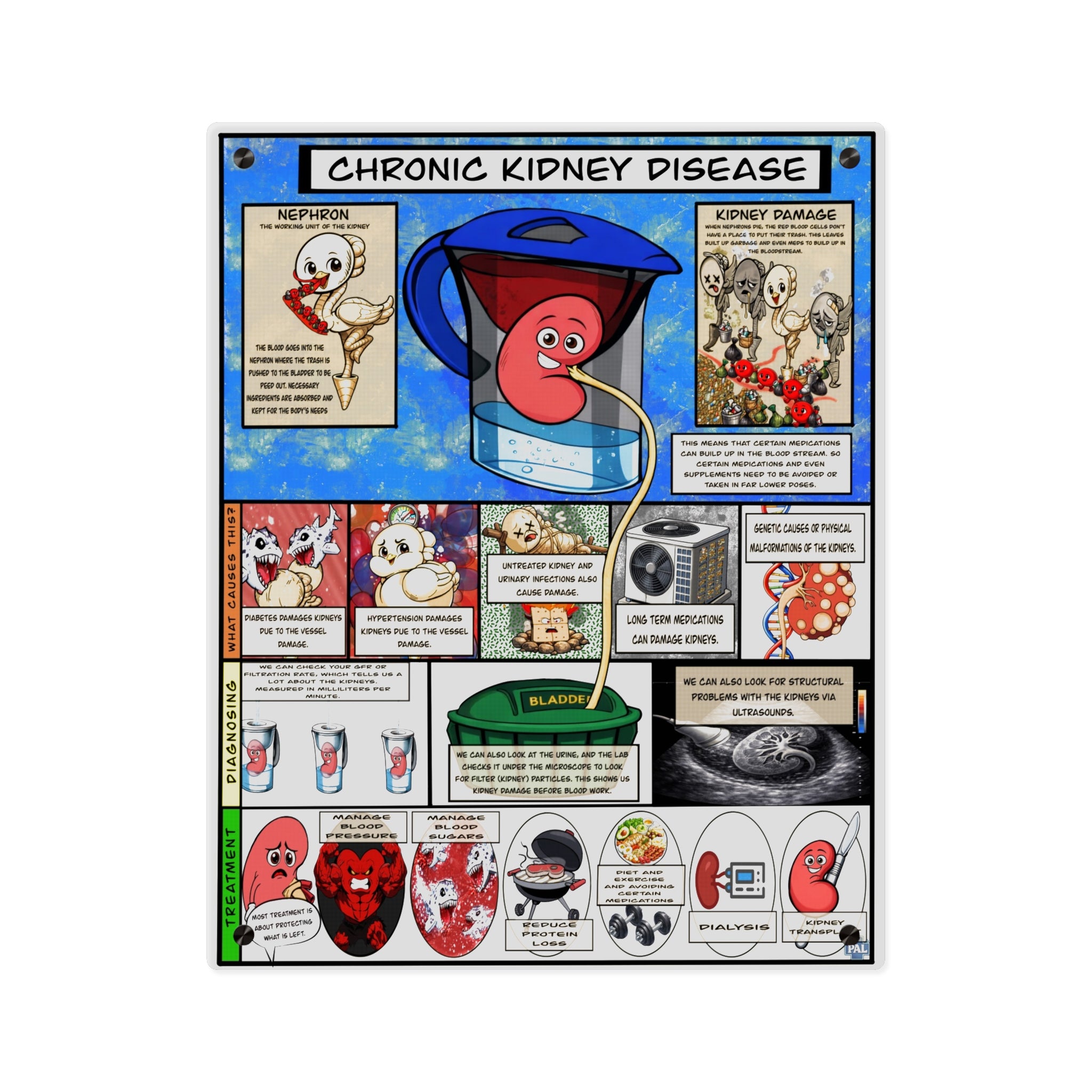 Chronic Kidney Disease Acrylic Wall Art Panel for Patient Education in Clinics and Hospitals